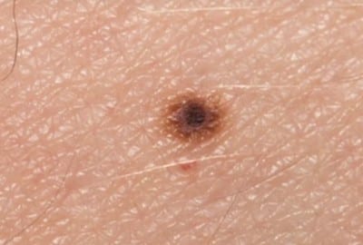 Algorithm allows computer to identify skin cancer